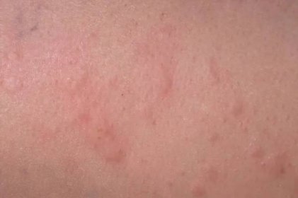 Alergická Reakce Závažné Případy Úlů — Stock fotografie