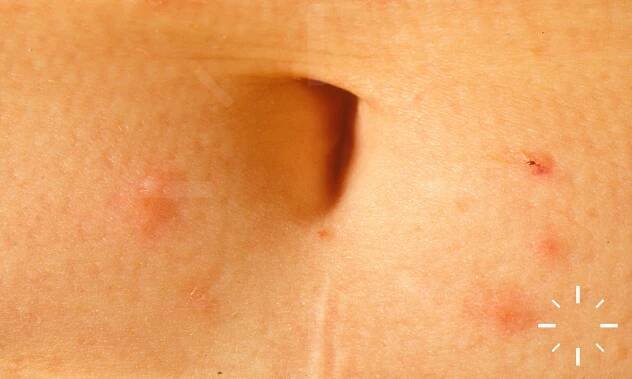 DermaCompass - Scabies 