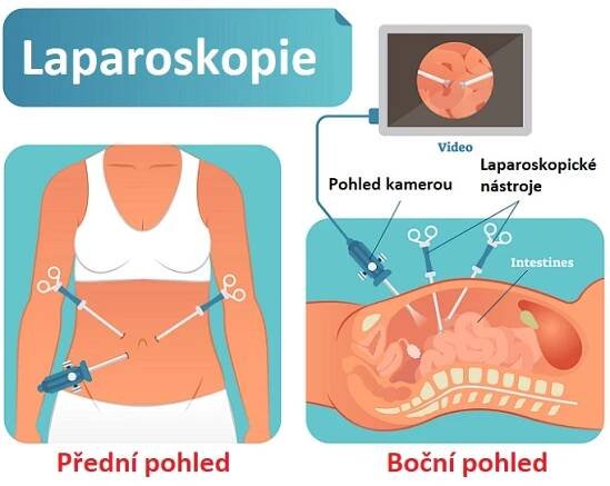 Laparoskopie - ilustrace