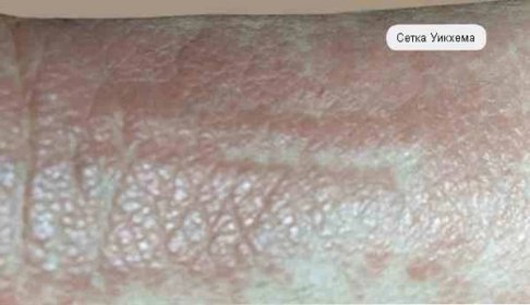 Příznaky a léčba lichen planus / Dermatologie | Užitečné informace a tipy na péči o sebe. Zdraví, výživa a další.