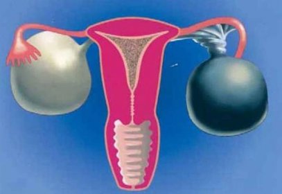 Twist nohy ovariálního nádoru naléhavě diagnostikovat a rozpoutat! / Články