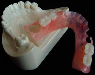 Nylonové protézy: Posouzení, cena, druhy | City Dental