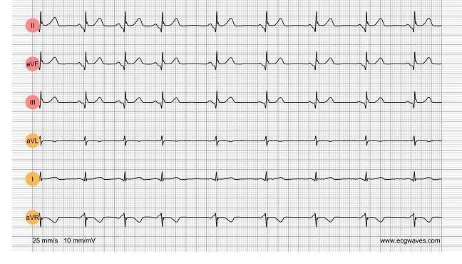 ECG Test (Quiz) Library: Question 8