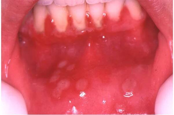 Herpes Simplex Virus (Hsv) Infection Of The Mouth European