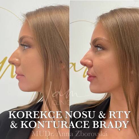 Zvětšení rtů, modelace brady a neoperativní korekce nosu.