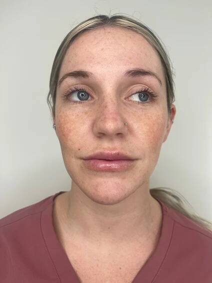 Before & After | LIP FILLER | | GLANZ Aesthetics | Doral, FL