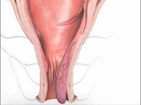 HAL-RAR Procedure Animation