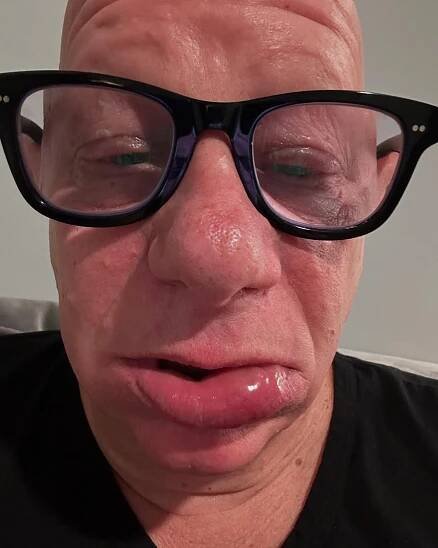 Jeff Ross Hospitalized for Allergic Reaction