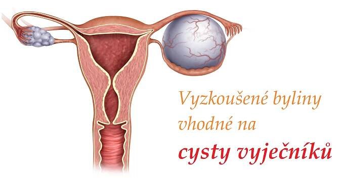 Cysty vaječníků - byliny, bylinky, léčivé rostliny, léčba bez léků a operace