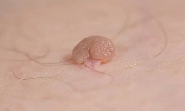 stopová kožní značka nebo akrochodon nebo měkký fibrom. papilloma bump na mužské tělo makro výstřel. fibroepithelial polyp na stonku. benigní léze epidermis zblízka. - papilom - stock snímky, obrázky a fotky
