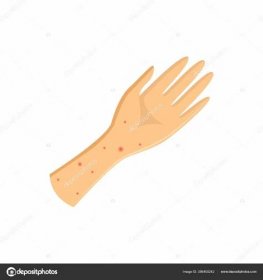 Vektorová alergická kůže ruky s vyrážkou Stock Vektor od ©Sabelskaya 386400242