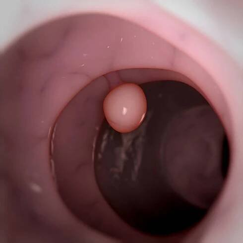 polyp tlustého střeva - polypy - stock snímky, obrázky a fotky