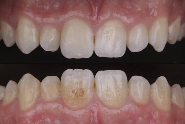 before and after minimally invasive brown spot removal