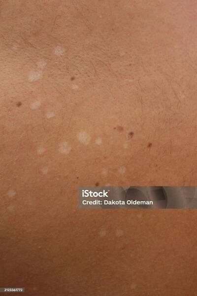 Porozumění Tinea versicolor: Zvládání a léčba Pityriasis versicolor - Bez autorských poplatků Barevný obrázek Stock fotka