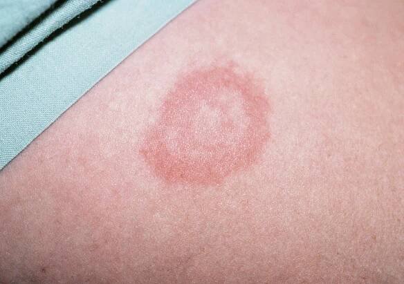 Tick Bitesgoodhousemag Types Of Bug Bites, Anti Itch Remedy, Heal Open Acne Wound, Types Of Bugs, Tick Bite, Bad Acne, Common Fears, Bug Bites, Mosquito Bite