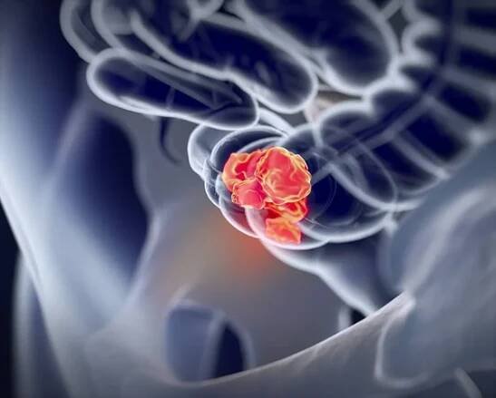 Colorectal Cancer