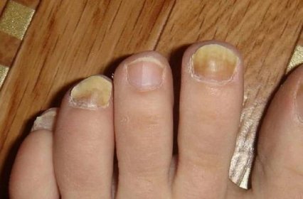 příznaky plísní na nehtech a kůži nohou