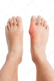 Stáhnout - Dvojice nohou s deformovaný pravý palec kvůli bolestivé dnu zánětu. — Stock obrázek