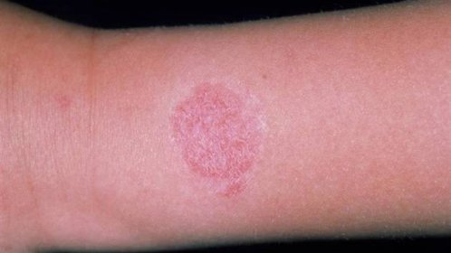 Kontaktní dermatitida, která se objevila po nošení hodinek. Kruhová červená vyrážka na pacientově zápěstí je způsobená alergií na nikl.