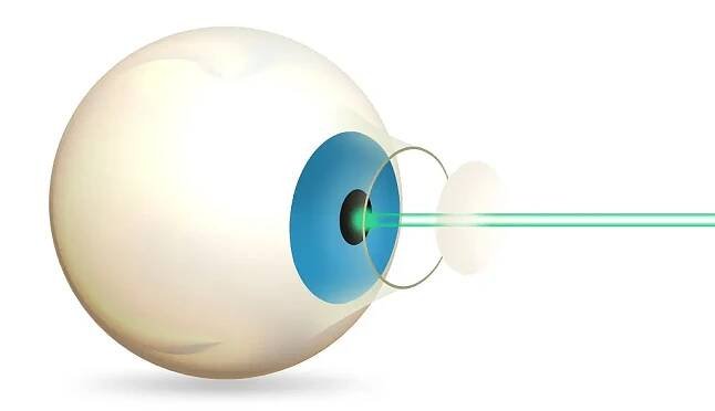 Vše co potřebujete vědět o operaci LASIK