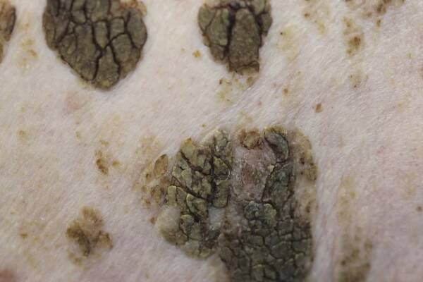 909 Archives - Skin Cancer 909