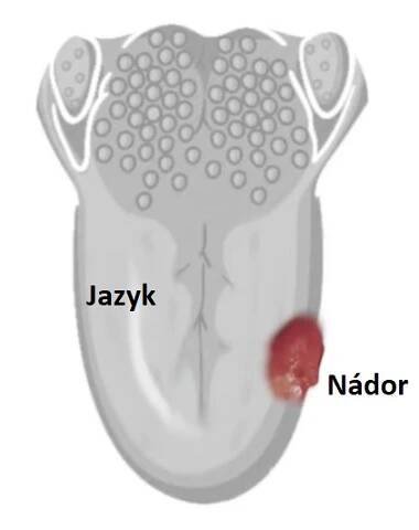 Rakovina jazyka je zhoubné nádorové onemocnění postihující buňky jazyka.