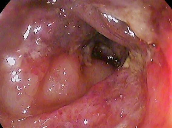 Ischemic colitis