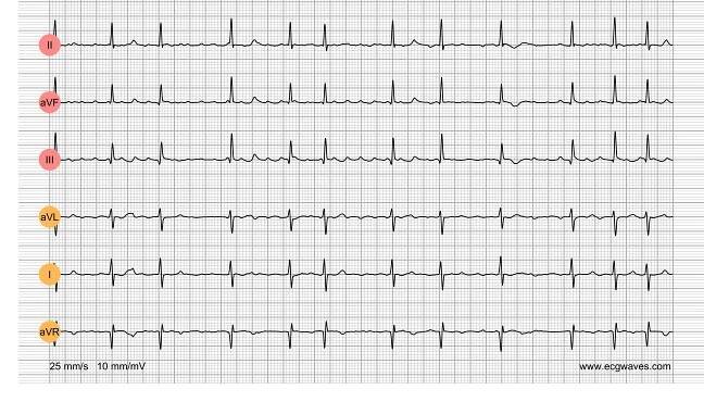 ECG Test (Quiz) Library: Question 5