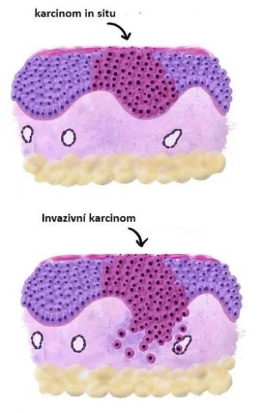 Karcinom in situ 4.67/5 (6)
