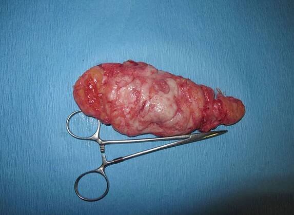 Gynecomastia anatomy