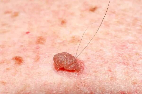 Nevus nebo papilom nebo krtek nebo melanom nebo keratóza na kůži dospělého — Stock obrázek