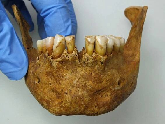 Nemoci našich předků (6): Choroby zubů a alveolů II – Abraze, paradentóza, zubní kámen....