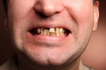První formy rakoviny dutiny ústní se mohou projevit jako neobvyklé načervenalé nebo bělavé plošky na sliznici
