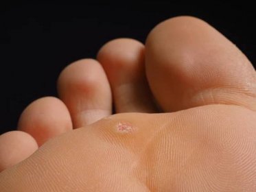 Detailní záběr na nohy s infikovaným bradavice pod prsty, izolované — Stock obrázek