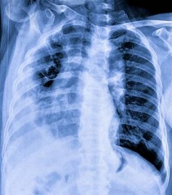 rentgenový film pacientů se zápalem plic. - bronchitida fotky - stock snímky, obrázky a fotky