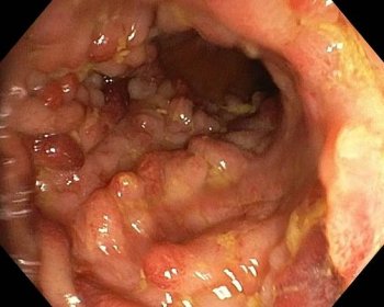 Polypóza u pacienta s ulceróznou kolitídou - Gastronenterologie-online