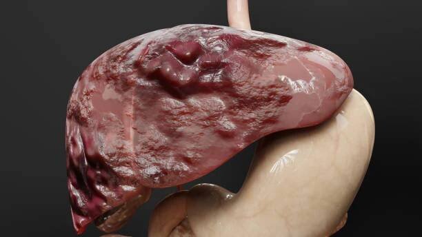 trávicí orgán rakovina jater, hepatitida cirhóza maligní nádor, selhání jater, rostoucí buňky, duplikace, fibróza, cirhóza, hepatocelulární karcinom, virus infikované játra, lidské, 3d render - gangréna - stock snímky, obrázky a fotky
