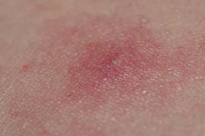 Alergická kožní vyrážka je červená . — Stock obrázek