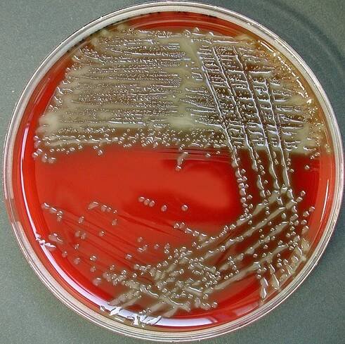 Meningitis