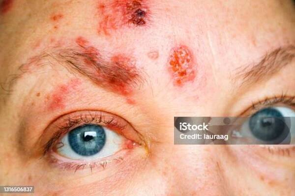 Stock fotografie Pásový Opar Na Obličeji A Kolem Oka Zvané Oftalmologické Herpes Zoster Nebo Herpes Zoster Oftalmáš – stáhnout obrázek nyní
