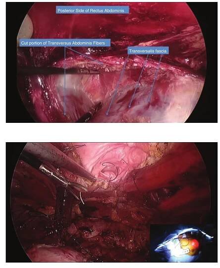retromuscular sublay position. The developed retromuscular space is measured for appropriate mesh size selection. Our preference is medium weight macroporous polypropylene mesh which is deployed through our 12 mm trocar (Fig. 9.12). There is no need for antiadhesion barriers as there now exists an autologous barrier between the mesh and viscera, a significant advantage of the sublay position. Mesh placement in the retro- muscular space has allowed for the discontinua- tion of aggressive penetrating fixation techniques with transfascial sutures, transitioning first to fibrin glue and, more recently, to complete cessa- tion of mesh fixation as our data illustrates pene- trating fixation is associated with higher incidence of chronic pain without the added benefit of low-  ered rates of recurrence. Pneumoperitoneum is released under direct vision, assuring the mesh is lying flat and wrinkle-free between the posterior and anterior layers.  Formerly, we once placed drains just superfi- cial to the mesh in all repair cases. We are now more selective with drain placement and do not utilize it for most patients. To date, we have not observed an increase in wound morbidity as a result.  Formerly, we once placed drains just superfi-  there now exists an autologous barrier between 