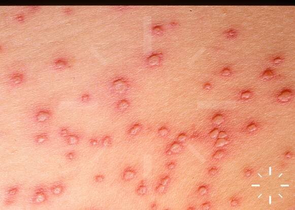 DermaCompass - Varicella 