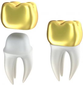 Zlatý zubní korunky a zub, izolované na bílém — Stock fotografie