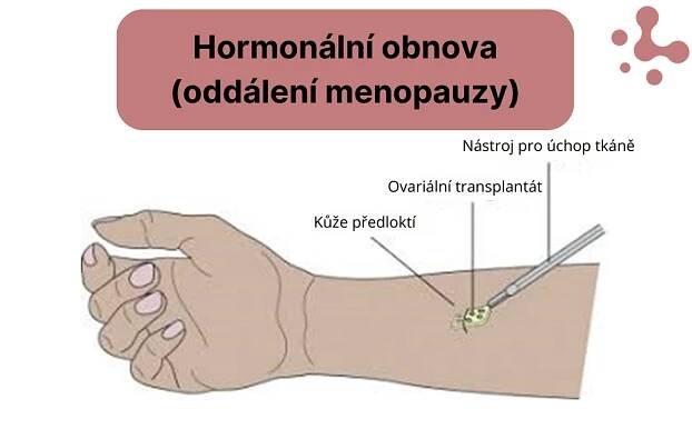 Podolí nabídne revoluční metodu prodloužení plodnosti. Zmrazí tkáň z vaječníku
