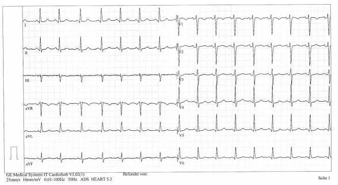 EKG FYZIOL