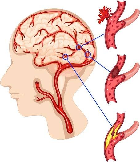 ateroskleróza diagnostika a léčba