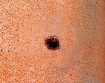 Existuje přes 2000 kožních chorob: Jak poznat melanom!