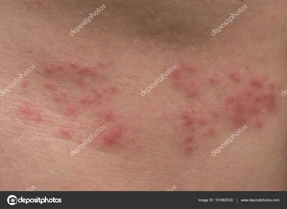 Detailní záběr na těle kůže s Herpes Zoster (pásový opar)