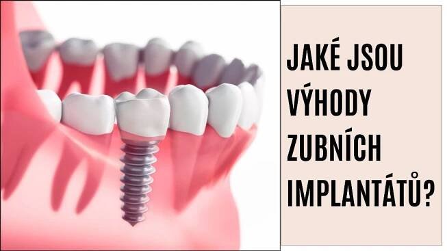 Jaké jsou výhody zubních implantátů