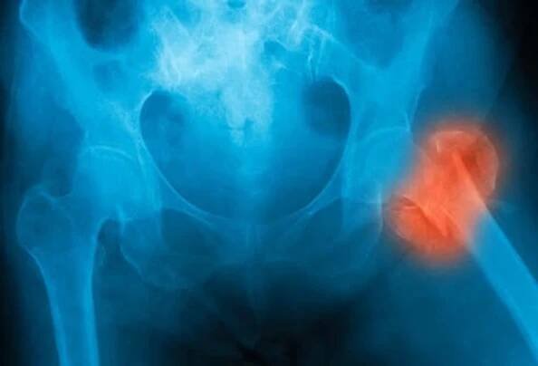 Bone Loss